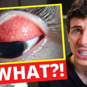 Contact Lenses Did THIS?! - What is GIANT Papillary Conjunctivitis (GPC)