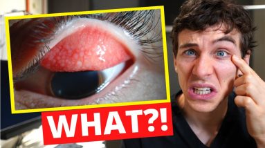 Contact Lenses Did THIS?! - What is GIANT Papillary Conjunctivitis (GPC)