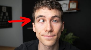CROSS EYED? What is Strabismus - (Types, Causes, Treatments) Eye Doctor Explains