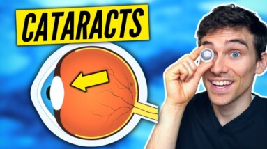 Cataracts Explained Simply - Symptoms, Causes, Treatments