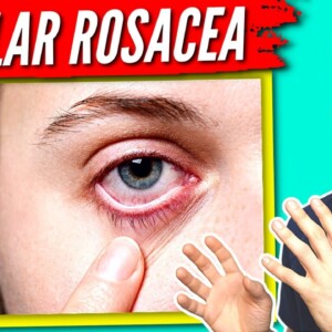 Ocular Rosacea Treatment - 7 Tips to Help get Relief!