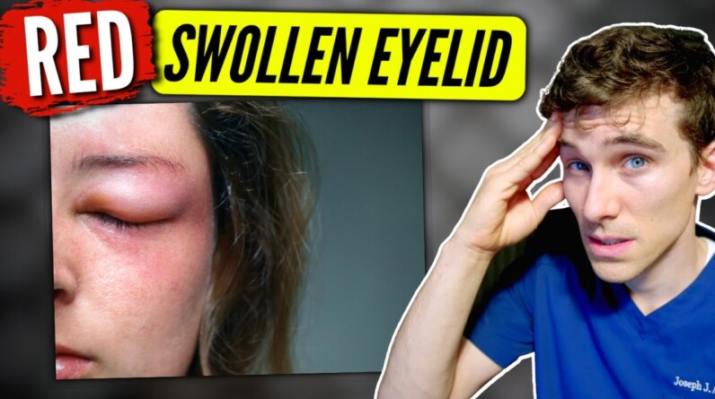 Swollen Eyelid: (causes & solutions) - Eye Doctor Explains