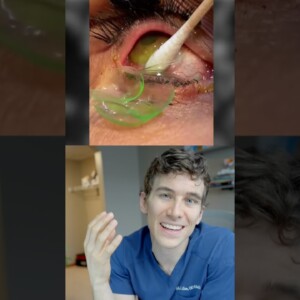 Removing 23 Contact Lenses Stuck in Eye Reaction